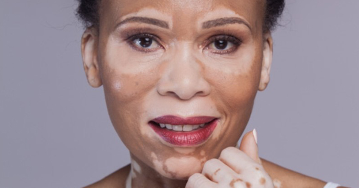 Santé/Tout connaitre sur le Vitiligo                               